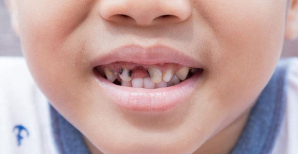 Dental Related Conditions